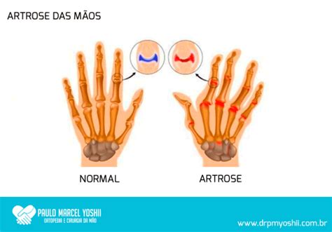 Artrose Dos Dedos Da M O Dr Paulo Marcel Yoshii