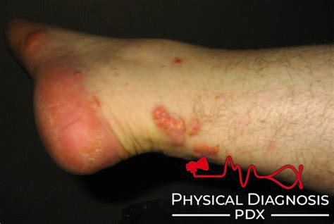 Eruptive Xanthoma Physical Diagnosis Pdx