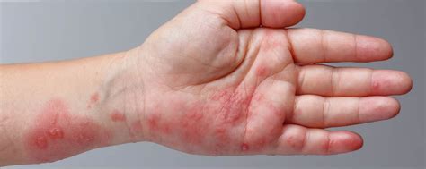 Ekzeme - Alles über Symptome, Auslöser und Behandlung