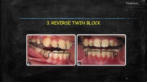 Class Iii Malocclusion Seminar