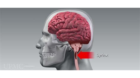 The Impact Of Chiari Malformation - El Paso, TX | Sciatica Pain and Treatment Clinic