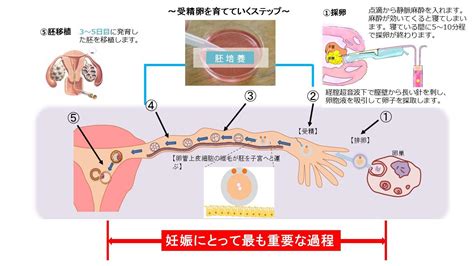 採卵（排卵）から胚移植（子宮内への胚移送） よくあるご質問 徐クリニック