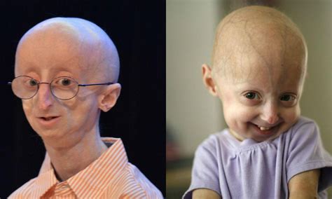 Progeria Facts