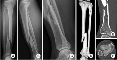 A C Anteroposterior Lateral X Rays Of A Distal One Third Tibial Shaft