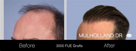 ARTAS Hair Transplant Toronto Plastic Surgeons