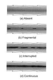 Medulla Patterns - Hair Structure and its role in forensic science