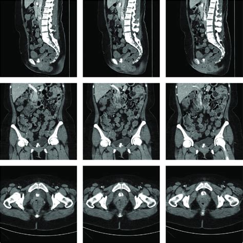 Sagittal Coronal And Axial Ct Scans Of The Abdomen And Pelvis Showing