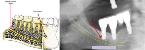 implant risk | Dental implants, Implants, Best dental implants