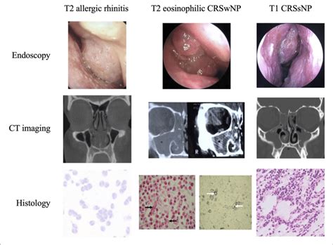 Typical Examples Of Endoscopic Ct And Histologic Sinonasal