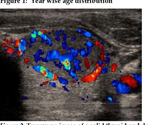 Figure 2 From Role Of Colour Doppler Ultrasonography In Differentiating