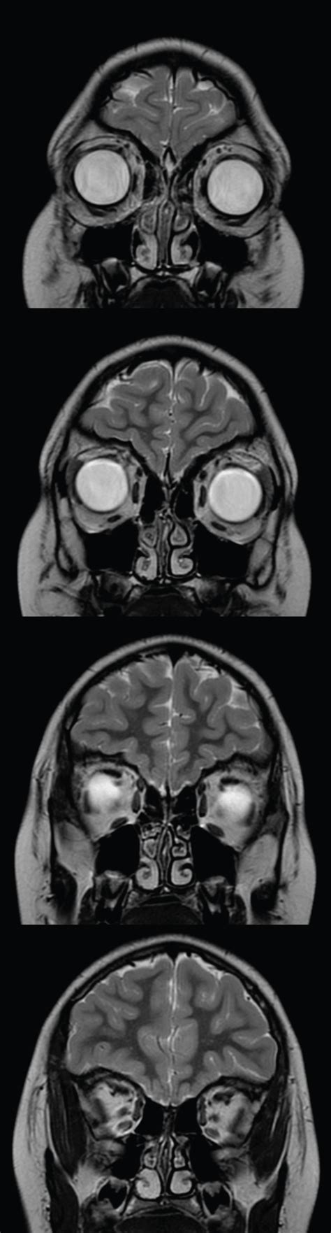 Olfactory Nerve Mri