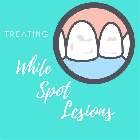 Treating White Spot Lesions