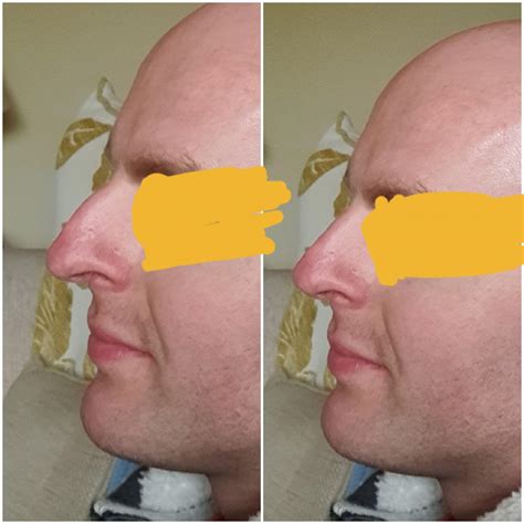 Rhinoplasty Morph I Would Like To Achieve Realistic Scrolller