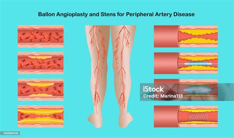 Vetores De Diagrama Mostrando Angioplastia Para Ilustração De Doença