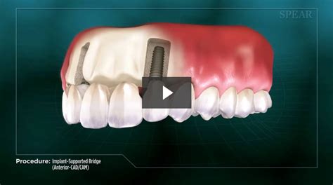 Implant-Supported Bridge (Anterior- CAD/CAM) - Cosmetic Dentistry