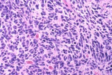 Medulloblastoma Pathology Definition Epidemiology Location