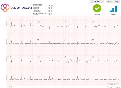 Sinus rhythm with Incomplete Right Bundle Branch Block - Ambulatory ECG ...