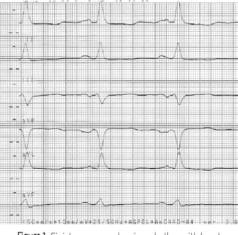 Figure 1 from CASE REPORT A 42-year-old patient with alcoholic cardiomyopathy | Semantic Scholar