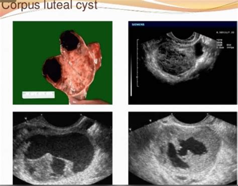 Ovarian Cysts Pelvic Mass Pid Flashcards Quizlet