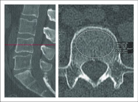 Ct Scan Of The Lumbar Spine With Demonstration Of Hu Measurement In The Download Scientific