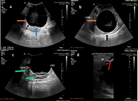 Imaging Diagnosis Of A Giant Choledochal Cyst In An Infant Semantic Scholar