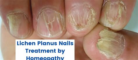 Lichen Planus Nails 10 Best Homeopathic Treatment