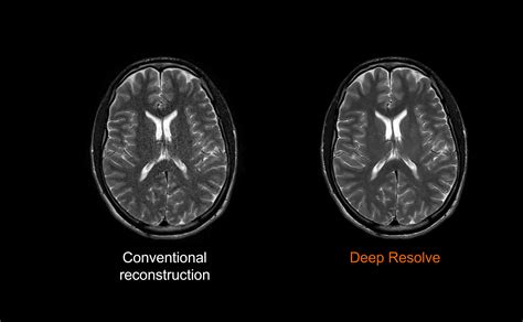 Siemens Healthineers Accelerates And Improves Magnetic Resonance