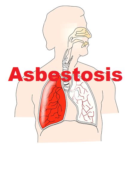 Malignant mesothelioma stories: Asbestosis is a disease that causes ...