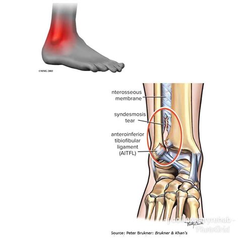 Ankle Syndesmosis