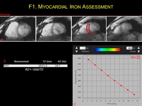 Myocardial Iron Assessment Cardiac Mri