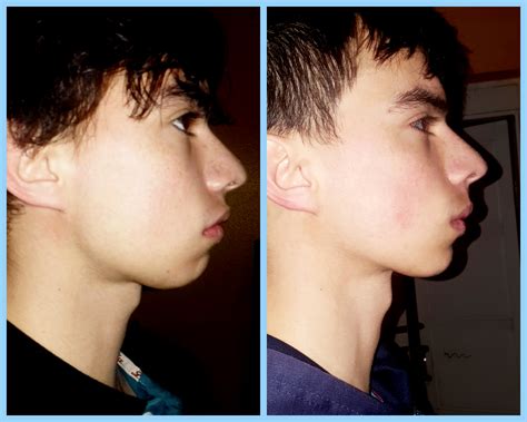 6 Month Mewing transformation (18M) : r/Mewing 