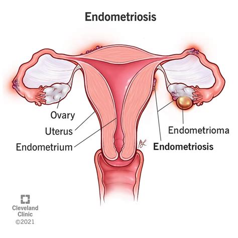 Symptoms Of Endometrial Cyst