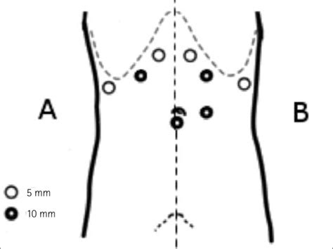 Trocar Placement For Transperitoneal Laparoscopic Adrenalectomy A