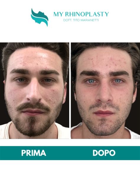 Setto Deviato My Rhinoplasty