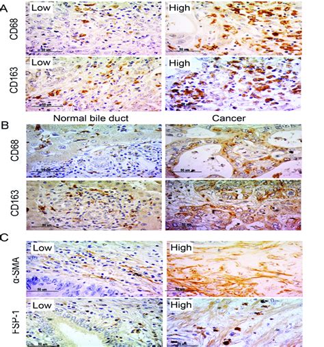 Staining Results A Low And High Density Of Cd68 And Cd163 Positive Download Scientific