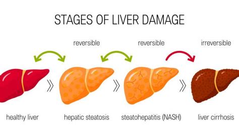 Liver Cirrhosis vs. NASH: Understanding the Differences and Similarities