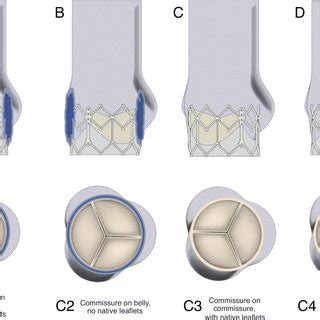 Vortical behaviour changes due to valve alignment. (A) Commissure to ...