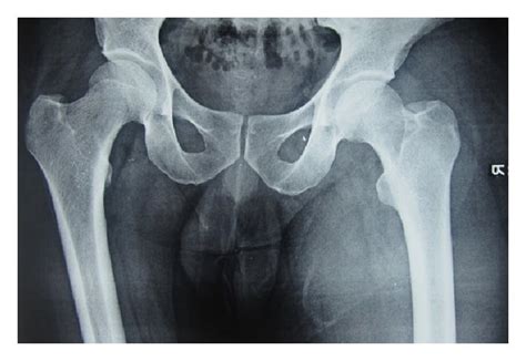 X Ray Bilateral Hip Joint—x Ray Showing A Normal Hip Joint And Femur Download Scientific