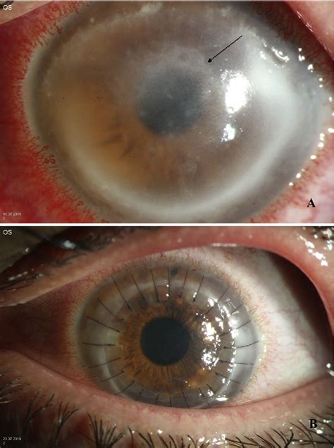 Figure 1 From Acanthamoeba Keratitis Clinical Signs Differential Diagnosis And Treatment