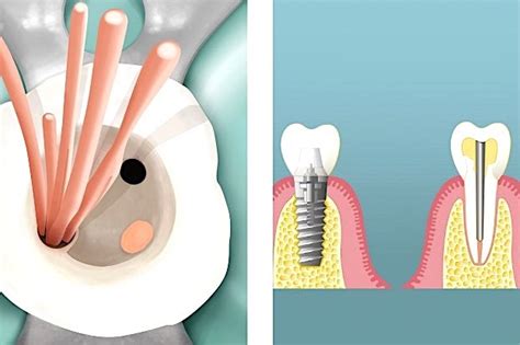 Stiftzahn Oder Implantat Gesundheit