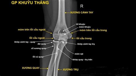 Những điều cần biết về phục hồi chức năng gãy trên lồi cầu xương cánh tay