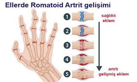 Romato D Artr T Lt Hapli Romat Zma Posturalgia