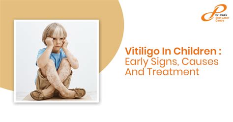 Vitiligo In Children: Early Signs, Causes And Treatment