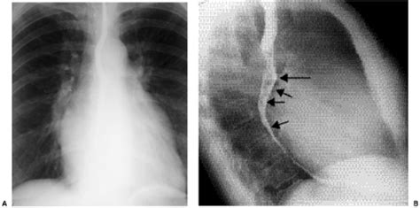 Acquired Cardiac Disease Thoracic Key