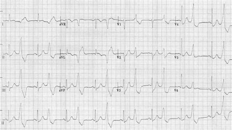 Premature Junctional Complex Pjc Litfl Ecg Library Diagnosis | The Best ...