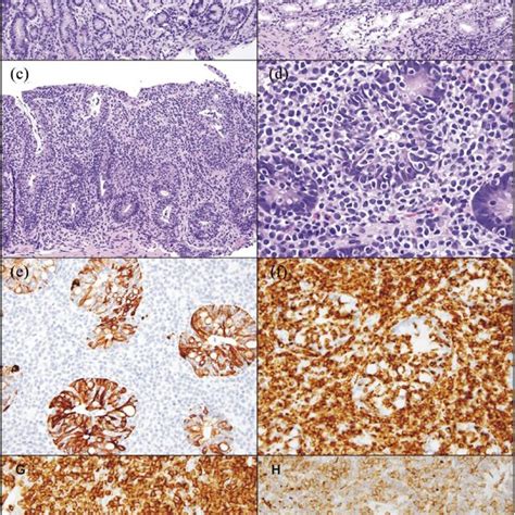 Esophagogastroduodenoscopy And Biopsies Of Case 1 A Erosions In The Download Scientific