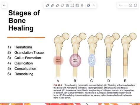 Bone stages of healing Flashcards | Quizlet