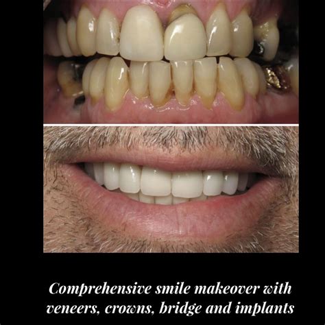 Veneers | New York Cosmetic Dentist