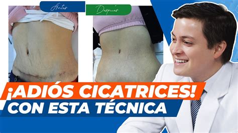 C Mo Quitar Las Cicatrices Post Quir Rgicas Medicina Est Tica En Per