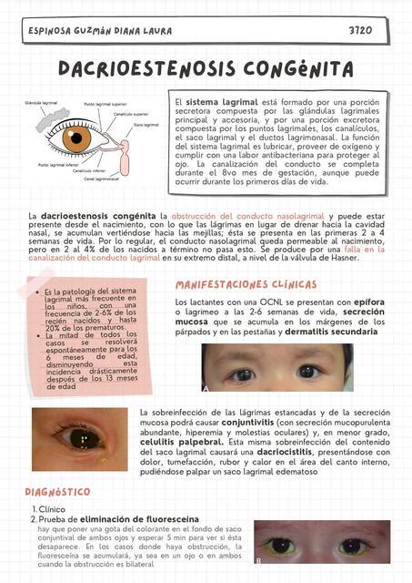 Dacrioestenosis Cong Nita Resumen Iovanny Cruz Ojeda Udocz